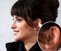 Celebrity Auricular Acupuncture Trend