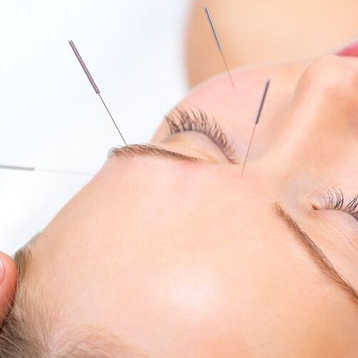 facial rejuvenation acupuncture